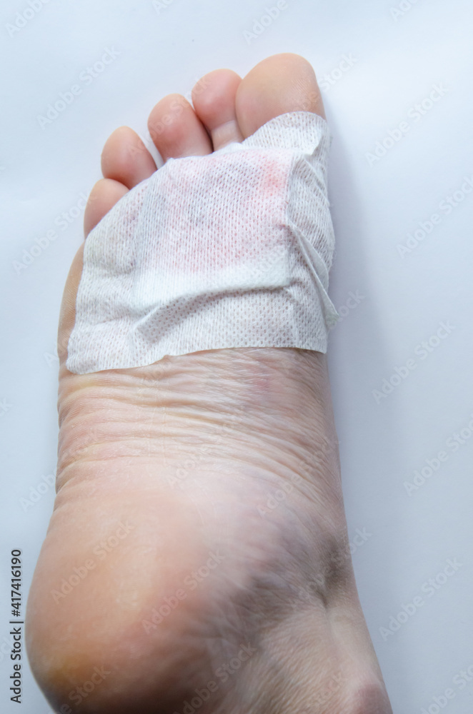 Close up foot with plaster after surgery to remove verruca. Injury feet. White patch protects the wound from dirt. Sealed bleeding wound. Caucasian adult woman's foot. Dermatological procedure. Close up foot with plaster after surgery to remove verruca. Injury feet. White patch protects the wound from dirt. Sealed bleeding wound. Caucasian adult woman's foot. Dermatological procedure.