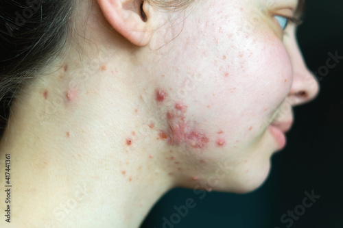 Pimples on the skin of a young girl close-up. Acne on the face of a teenage girl. Problems and treatment of acne in young people. Skin rashes, allergies. Keloids. The medical concept is puberty.