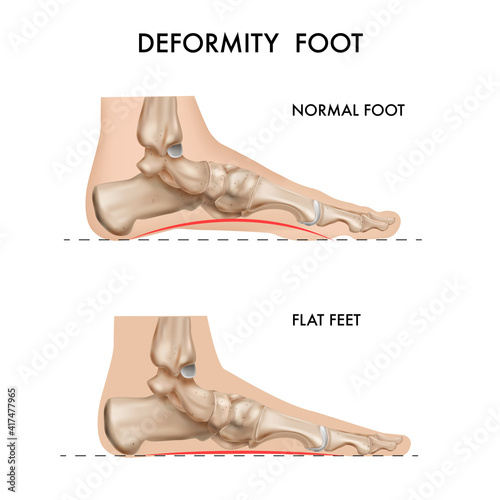 Foot Bones Deformation Composition