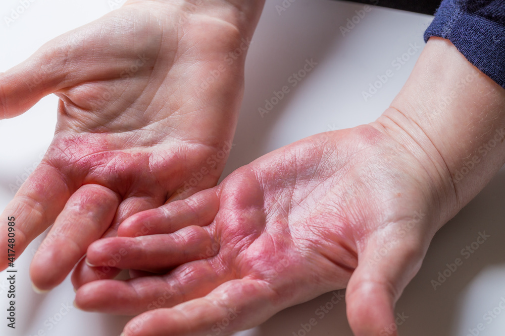 Fototapeta premium Atopic dermatitis, Red, itchy hands with blisters and chapped skin.