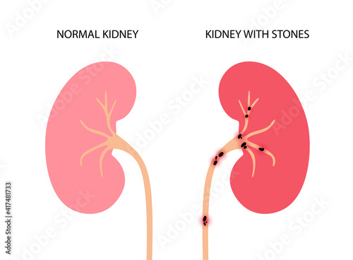 Kidney disease concept