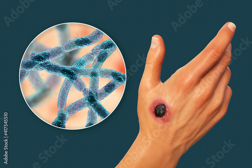 Bild auf Leinwand Cutaneous anthrax, the most common form of anthrax