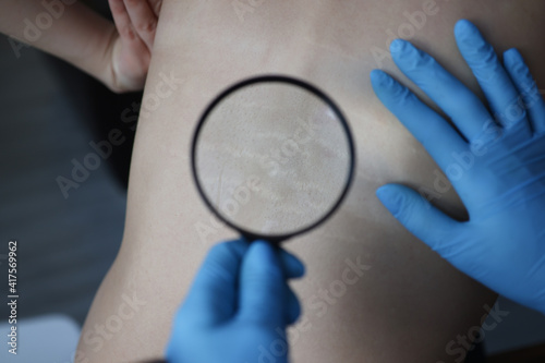 Doctor examining stretch marks on patients back using magnifying glass closeup. Hormonal disorders concept