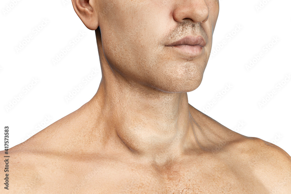 Thyroid cancer, tumor inside thyroid gland Thyroid cancer, tumor inside thyroid gland
