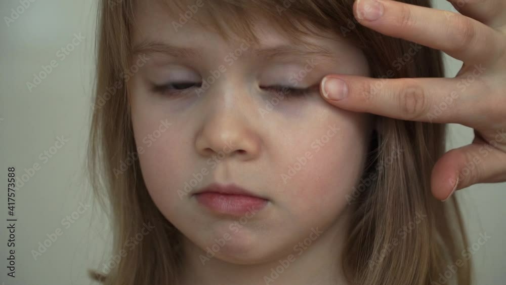 Close up of mothers hands smear bruise on eye of little girl antiphlogistic ointment. Injury treatment. Health and care concept Close up of mothers hands smear bruise on eye of little girl antiphlogistic ointment. Injury treatment. Health and care concept