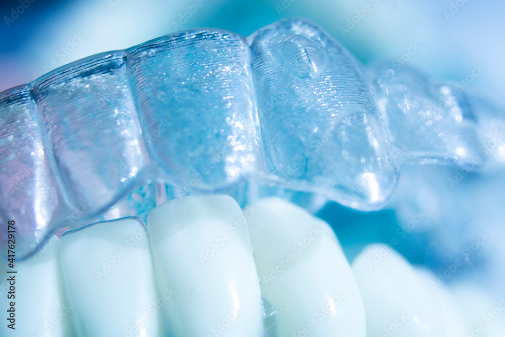 Invisible bracket aligners Invisible bracket aligners