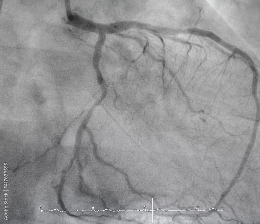 Coronary angiogram , medical x-ray for heart disease. Coronary artery ...