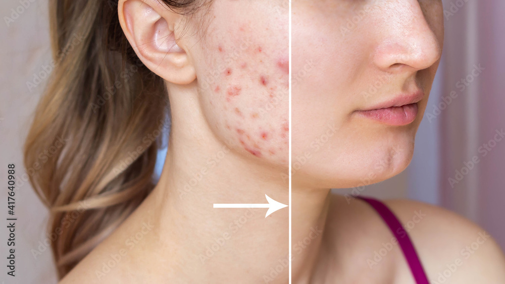 faces with acne vulgaris