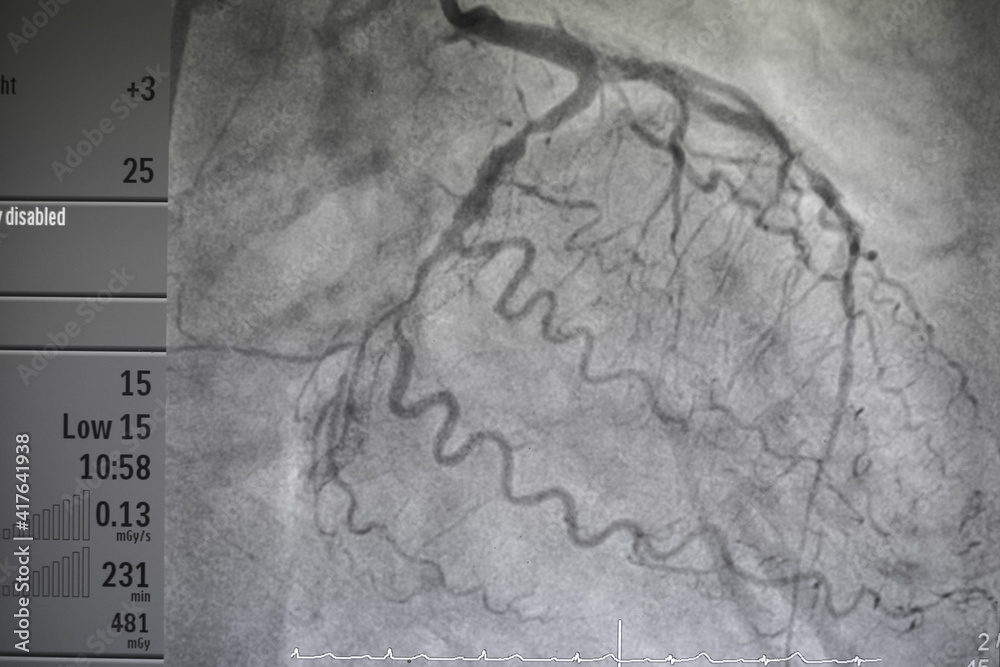 Coronary angiogram , medical x-ray for heart disease. Coronary artery ...