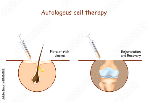 prp. Platelet-rich plasma. Autologous cell therapy photo