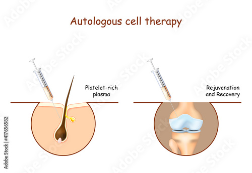 prp. Platelet-rich plasma. Autologous cell therapy