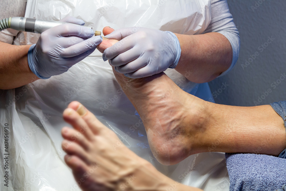Medizinische Fußpflege-Behandlung beim Mann