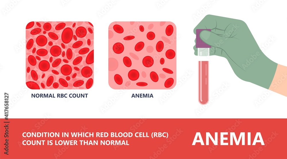 Iron infusion for anemia IV treat level red blood cells RBC loss low ...