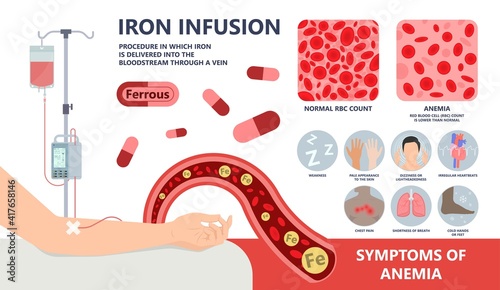 Iron infusion for anemia IV treat level red blood cells RBC loss low supplement