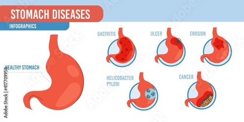 Vector flat cartoon infographic,healthy stomach and list of diseases-human internal organs diagnostics,medical treatment and therapy concept