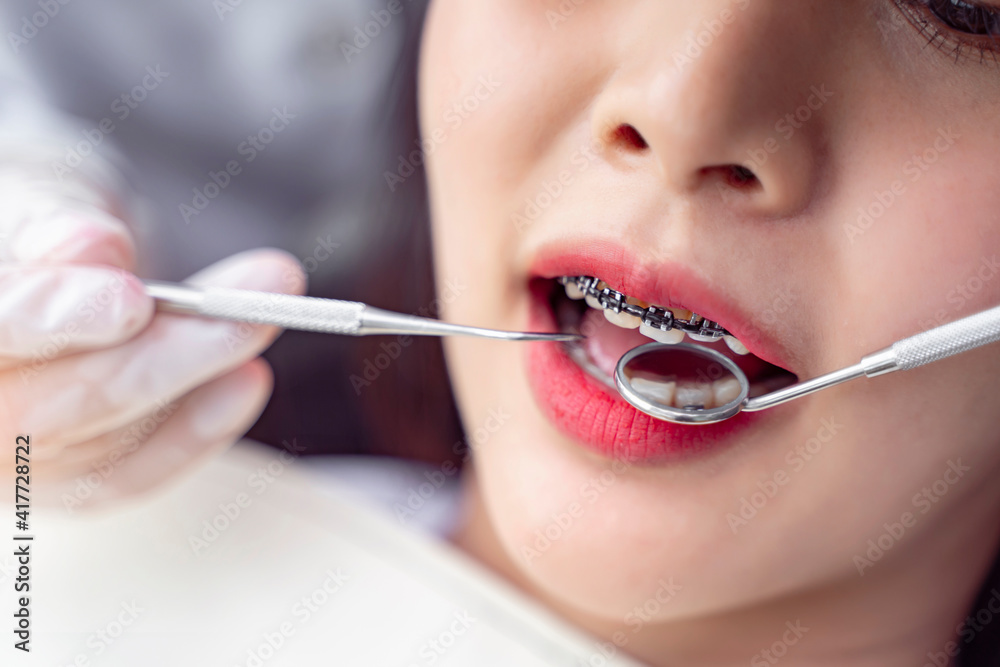 Close up mouth female girl having dental checkup placing braces for good teeth hygiene and health with dentist specialist orthodontist using tools checking mouth, hospital surgery room medical care Close up mouth female girl having dental checkup placing braces for good teeth hygiene and health with dentist specialist orthodontist using tools checking mouth, hospital surgery room medical care