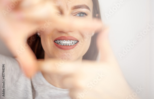 A girl with braces on her white teeth through a frame from her hands.
