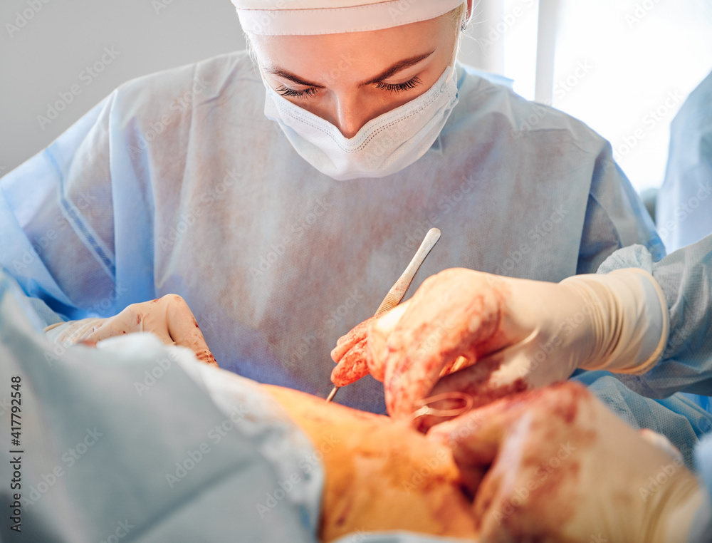 Female surgeon in medical mask performing plastical surgical operation in operating room in hospital. Young woman doctor doing abdominal plastic surgery. Concept of abdominoplasty and cosmetic surgery