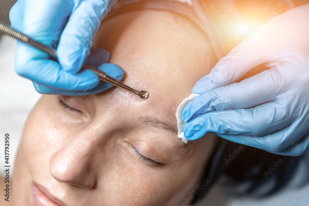 Close-up detail of beautician doctor hand in blue rubber protective gloves make blackhead spot pimples removal procedure for young adult female patient. Woman facial cleansing and skin care concept Close-up detail of beautician doctor hand in blue rubber protective gloves make blackhead spot pimples removal procedure for young adult female patient. Woman facial cleansing and skin care concept