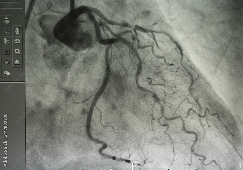 coronary-angiogram-medical-x-ray-for-heart-disease-coronary-artery