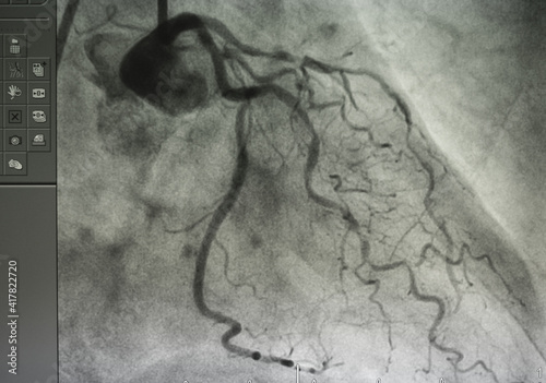 Coronary angiogram , medical x-ray for heart disease. Coronary artery disease. photo