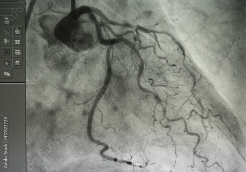 Coronary angiogram , medical x-ray for heart disease. Coronary artery disease.