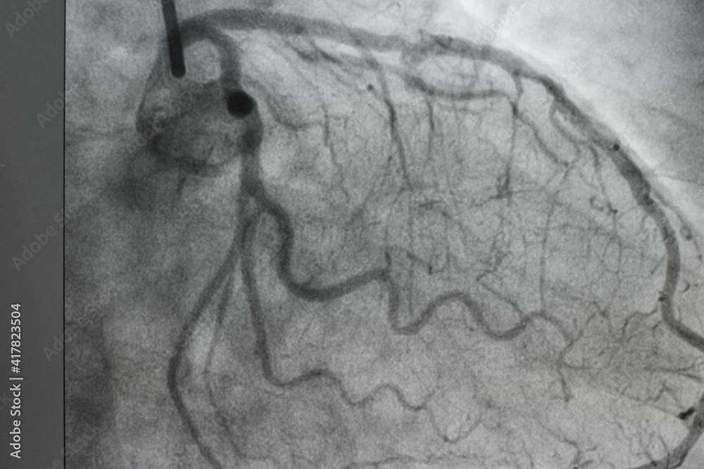 Coronary angiogram , medical x-ray for heart disease. Coronary artery ...