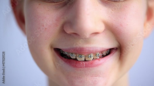 Close up of a teenage girl smiling in orthodontic brackets. Girl with braces on teeth. Orthodontic Treatment.