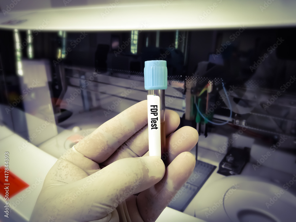 DDimer,FDP test. Corona patient monitoring test in ICU. Doctor