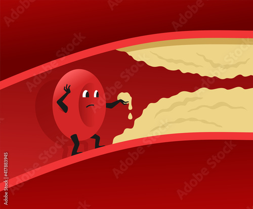 Cholesterol in blood vessel. Risk of infarction