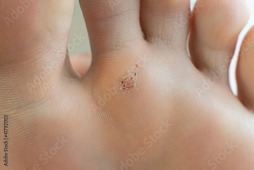 wart on a blunt close-up. Macro shot of human papilloma on the foot. photo