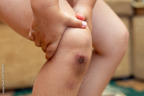 Painful knee injury, childhood injury, accident, child holding on to injured knee