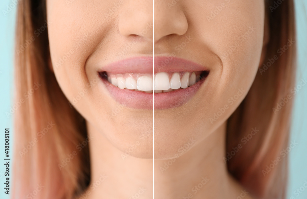 Young woman before and after procedure of gingival plasty, closeup