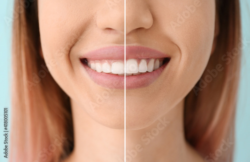 Young woman before and after procedure of gingival plasty, closeup photo