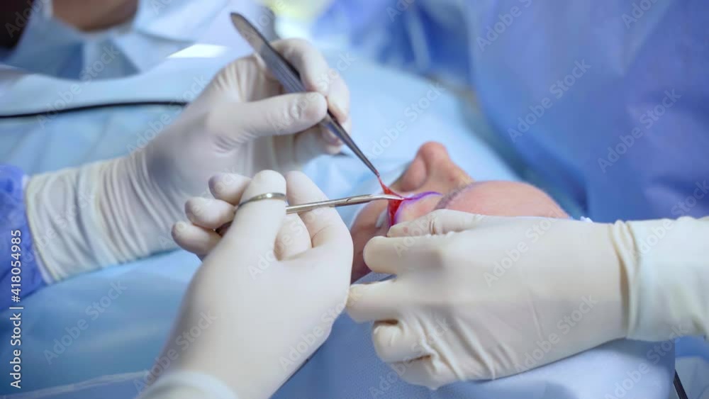 Blepharoplasty plastic surgery operation for modifying the eye region of the face in medical clinic. 2 doctors do plastic cosmetic operation for woman. Surgeon sutures the eyelid Blepharoplasty plastic surgery operation for modifying the eye region of the face in medical clinic. 2 doctors do plastic cosmetic operation for woman. Surgeon sutures the eyelid