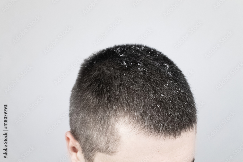 Dandruff on a man's shoulder. Side view of a man who has more dandruff flakes on his black shirt. Scalp disease treatment concept. Discomfort from a fungal infection Dandruff on a man's shoulder. Side view of a man who has more dandruff flakes on his black shirt. Scalp disease treatment concept. Discomfort from a fungal infection