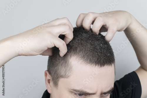 Dandruff on a man's shoulder. Side view of a man who has more dandruff flakes on his black shirt. Scalp disease treatment concept. Discomfort from a fungal infection photo