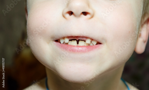 close-up - missing teeth from the upper jaw of a child