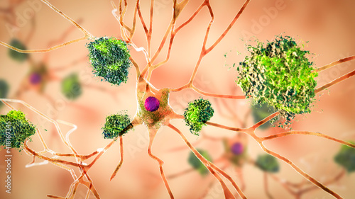 Neurons in Alzheimer's disease photo