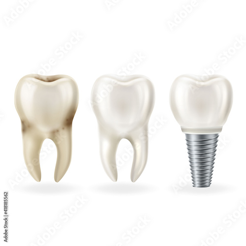 Realistic healthy tooth,tooth with caries and dental implant with screw. Vector illustratio
