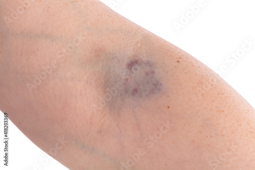 Arm with a hematoma after blood donation
