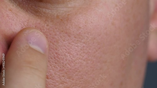 Man with acne long-term skin disease near nose. Beauty, skin care lifestyle concept. Pimples on face