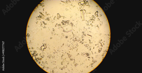 Crystallized urine sample due to kidney disease seen under the light microscope without staining or treatment. Microscopic crystals in a liquid sample.