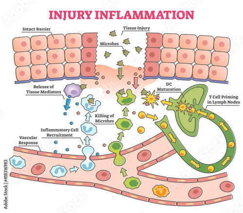 Injury inflammation as body response process in educational outline diagram photo