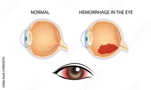 Hemorrhage in the eye, vector medical illustration