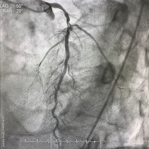 Coronary angiogram shown left anterior descending artery (LAD) stenosis with coronary aneurysm during cardiac catheterization.