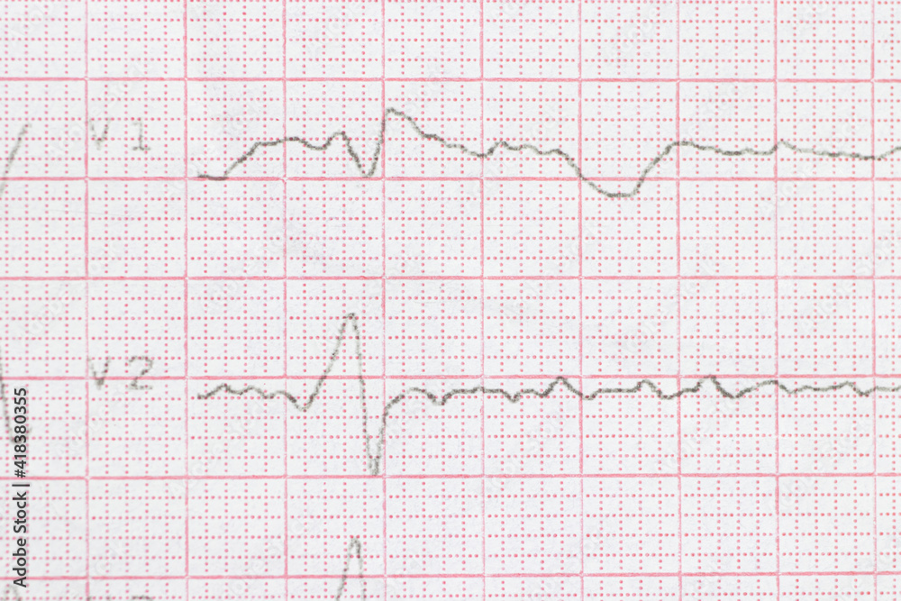 Macro or close-up ECG cardiogram of a patient with left bundle branch block. Diagnosis and treatment of heart disease