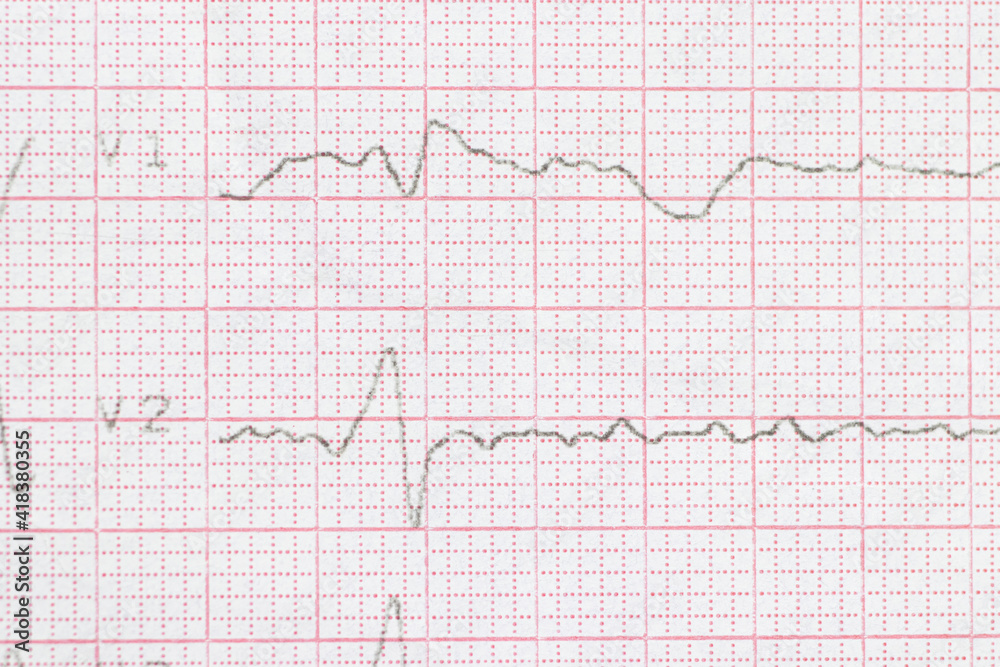 Macro or close-up ECG cardiogram of a patient with left bundle branch block. Diagnosis and treatment of heart disease Macro or close-up ECG cardiogram of a patient with left bundle branch block. Diagnosis and treatment of heart disease