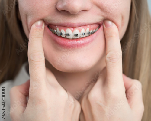 Close-up of a young woman's smile with metal braces on her teeth. Correction of bite