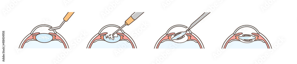 白内障手術の図解 Stock Illustration | Adobe Stock